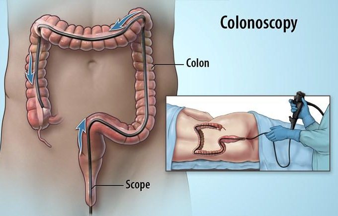 Colonoscopy for Diagnosing Irritable Bowel Syndrome