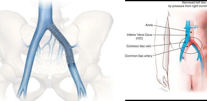May-Thurner Syndrome: Understanding Symptoms, Diagnosis, and Treatment Options