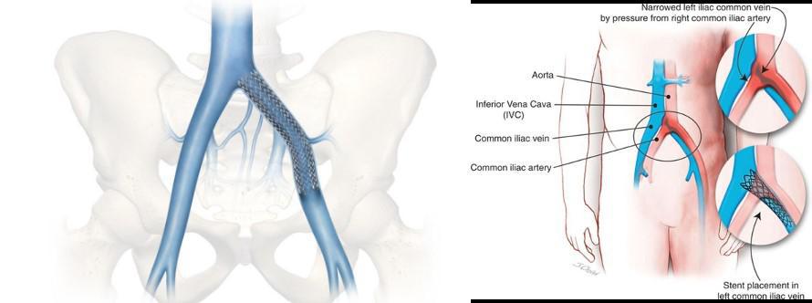 May-Thurner Syndrome: Understanding Symptoms, Diagnosis, and Treatment Options