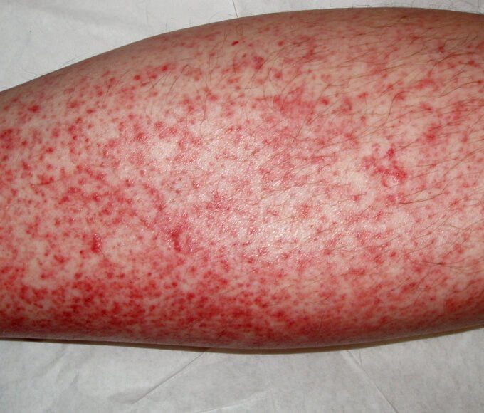 Dress Syndrome: A Comprehensive Guide to Understanding and Managing DRESS