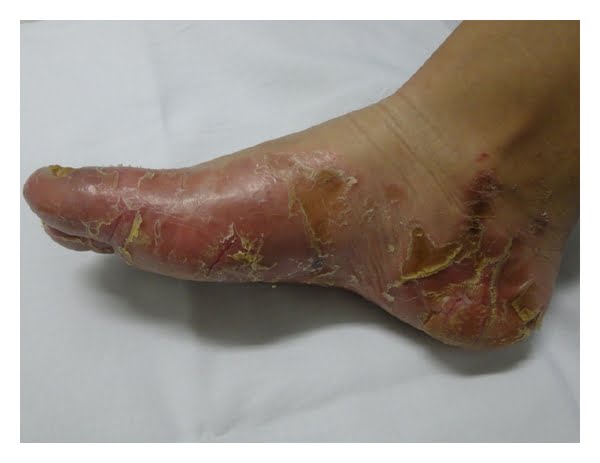 Olmsted Syndrome: Unraveling the Enigmatic Skin Disorder and Fostering Hope