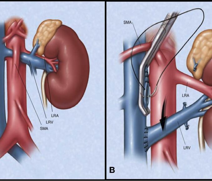 Nutcracker Syndrome: A Comprehensive Guide to Symptoms, Causes, Diagnosis, and Treatment