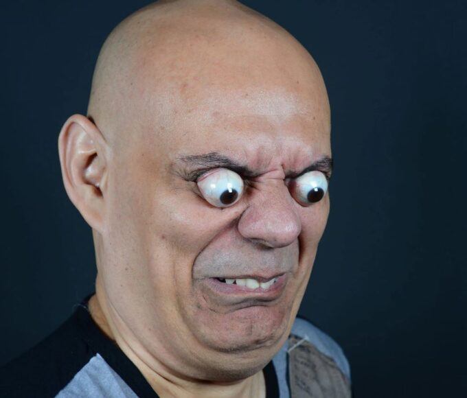 Understanding Crouzon Syndrome: Causes, Symptoms, and Treatment Options