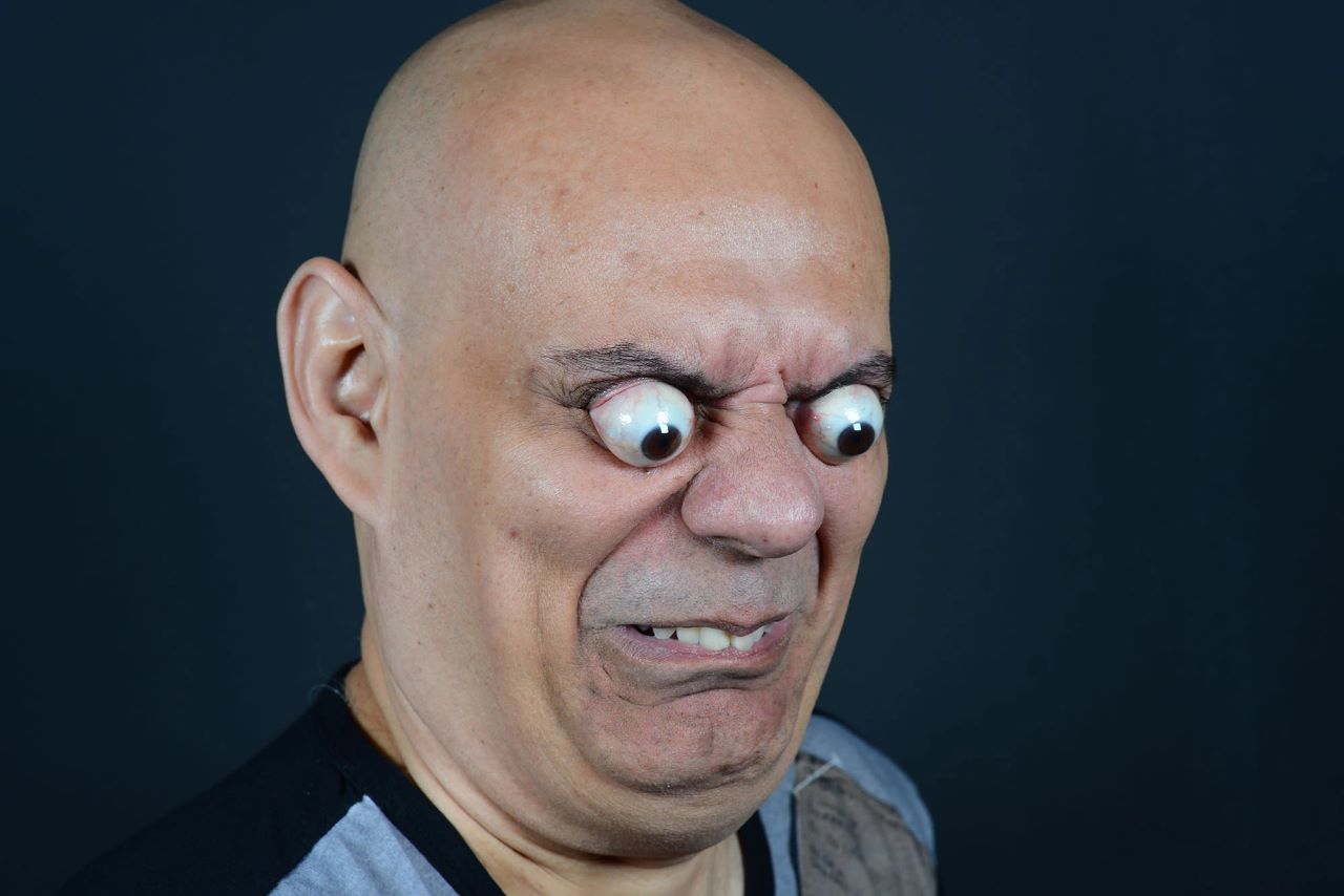 Understanding Crouzon Syndrome: Causes, Symptoms, and Treatment Options