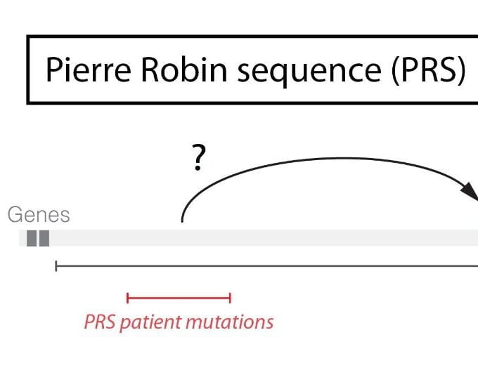Pierre Robin Syndrome: Causes, Symptoms, Treatment, and Support for Breathing, Speech, and Jaw Development