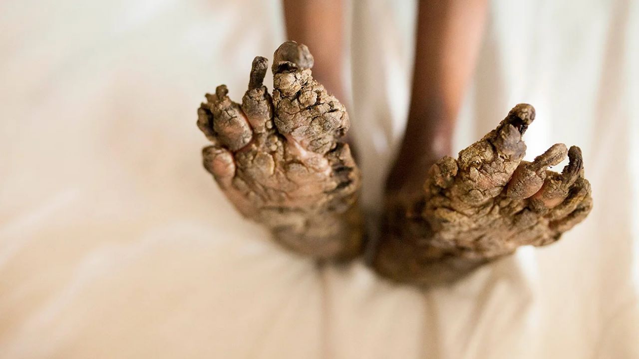 Tree Man Syndrome: Causes, Symptoms, Treatment, and Research Updates